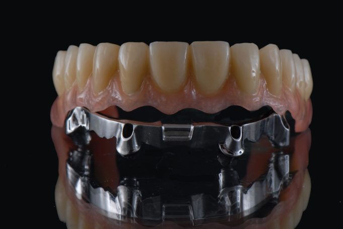 Stegverankerte Implantatbrücke