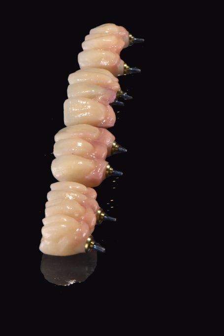 Feste Zähne auf Implantaten verschraubt